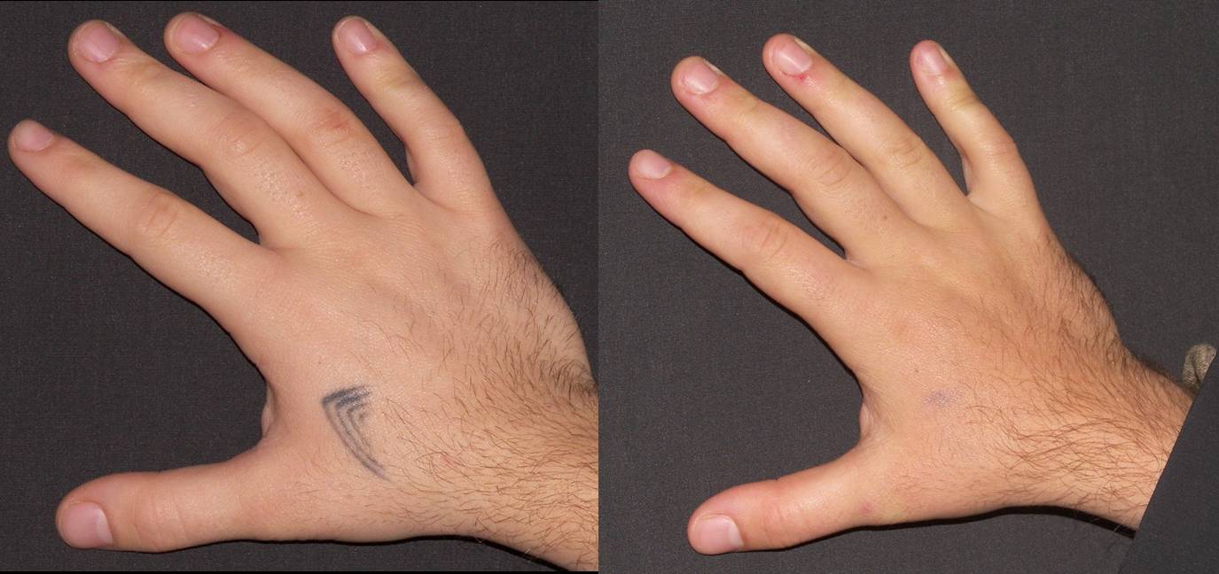tattoo-removal-hand-1.jpg